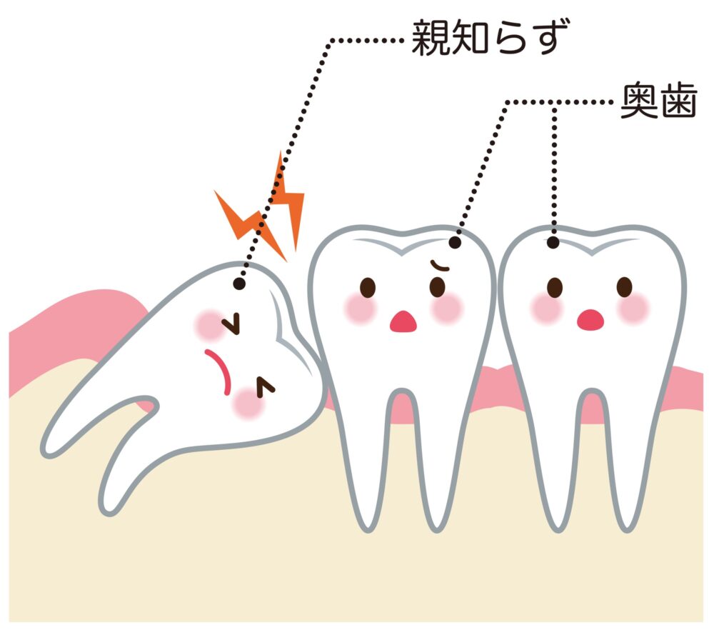 トラブルが起きる前に抜歯を