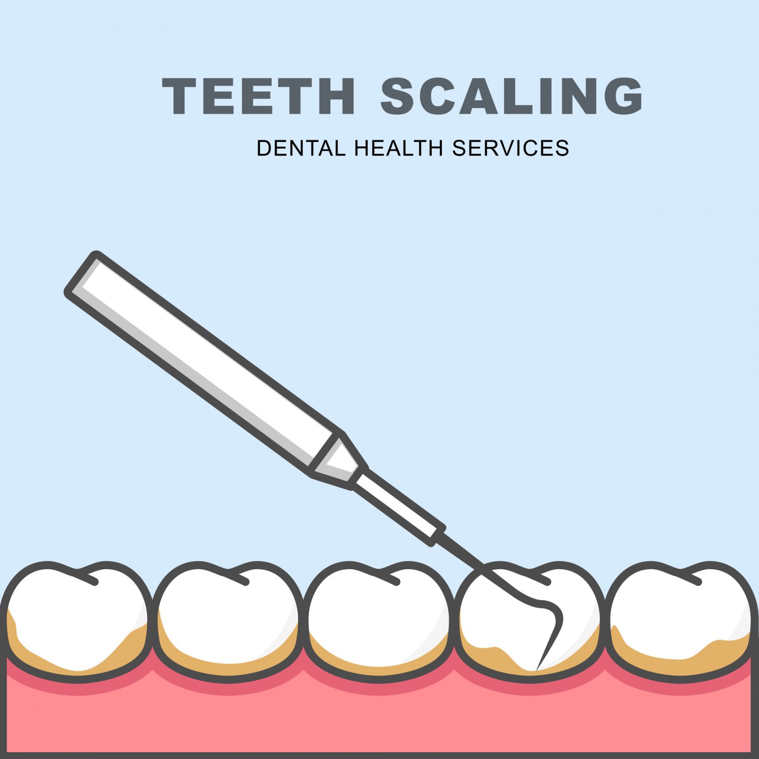 PMTC（Professional Mechanical Tooth Cleaning）