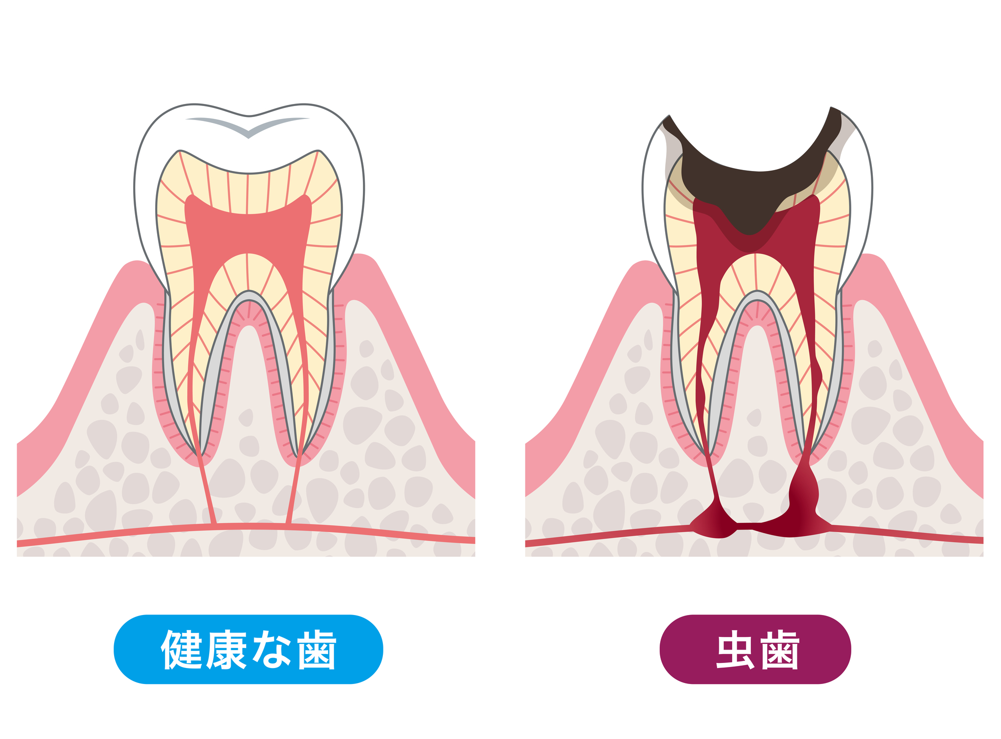 むし歯の進行